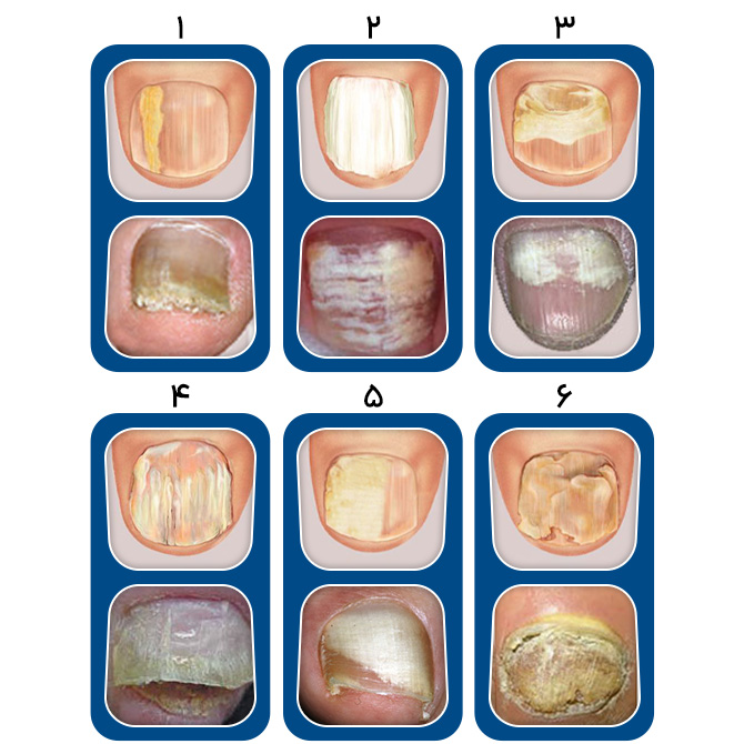 انواع قارچ ناخن