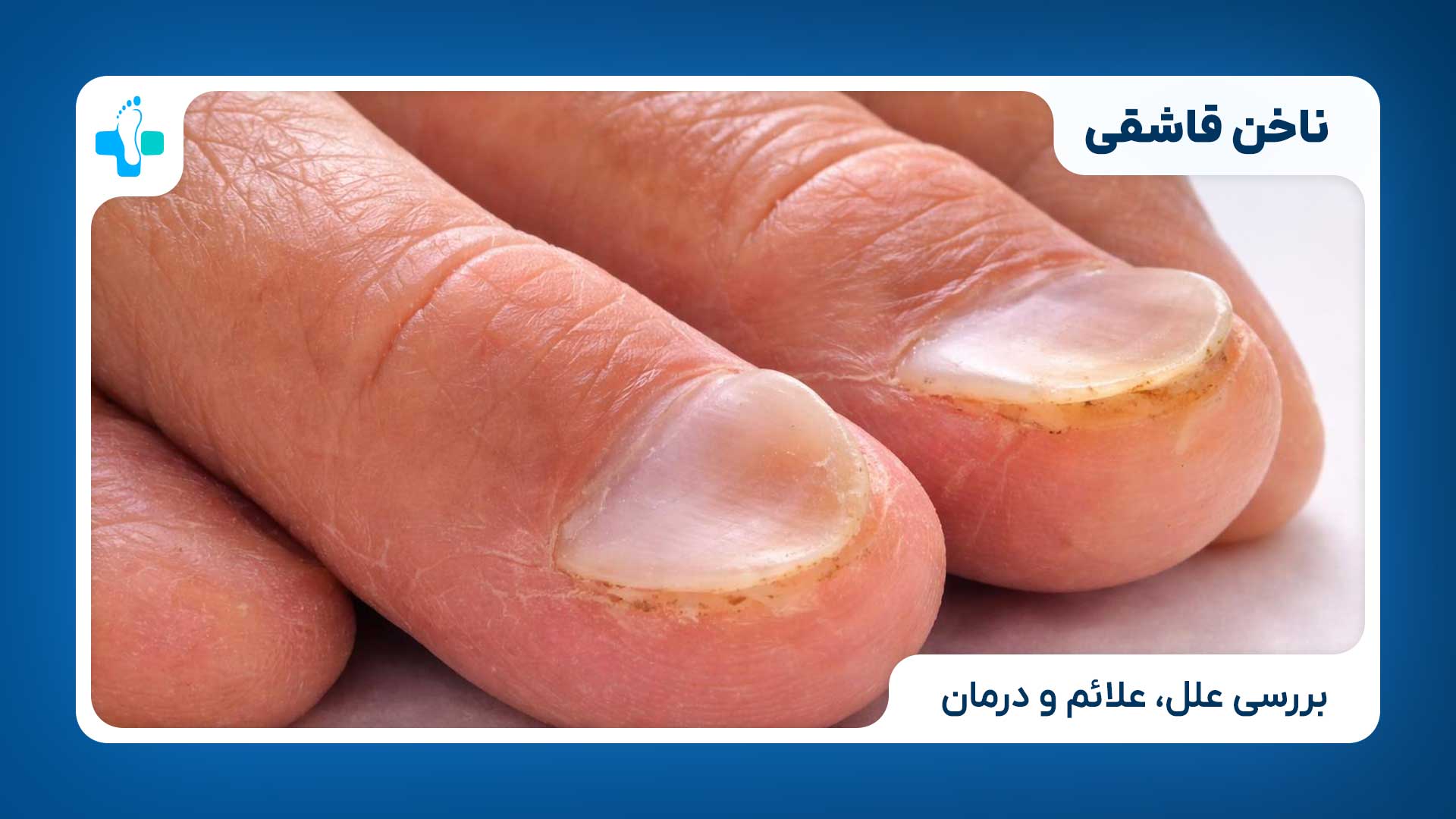 ناخن قاشقی