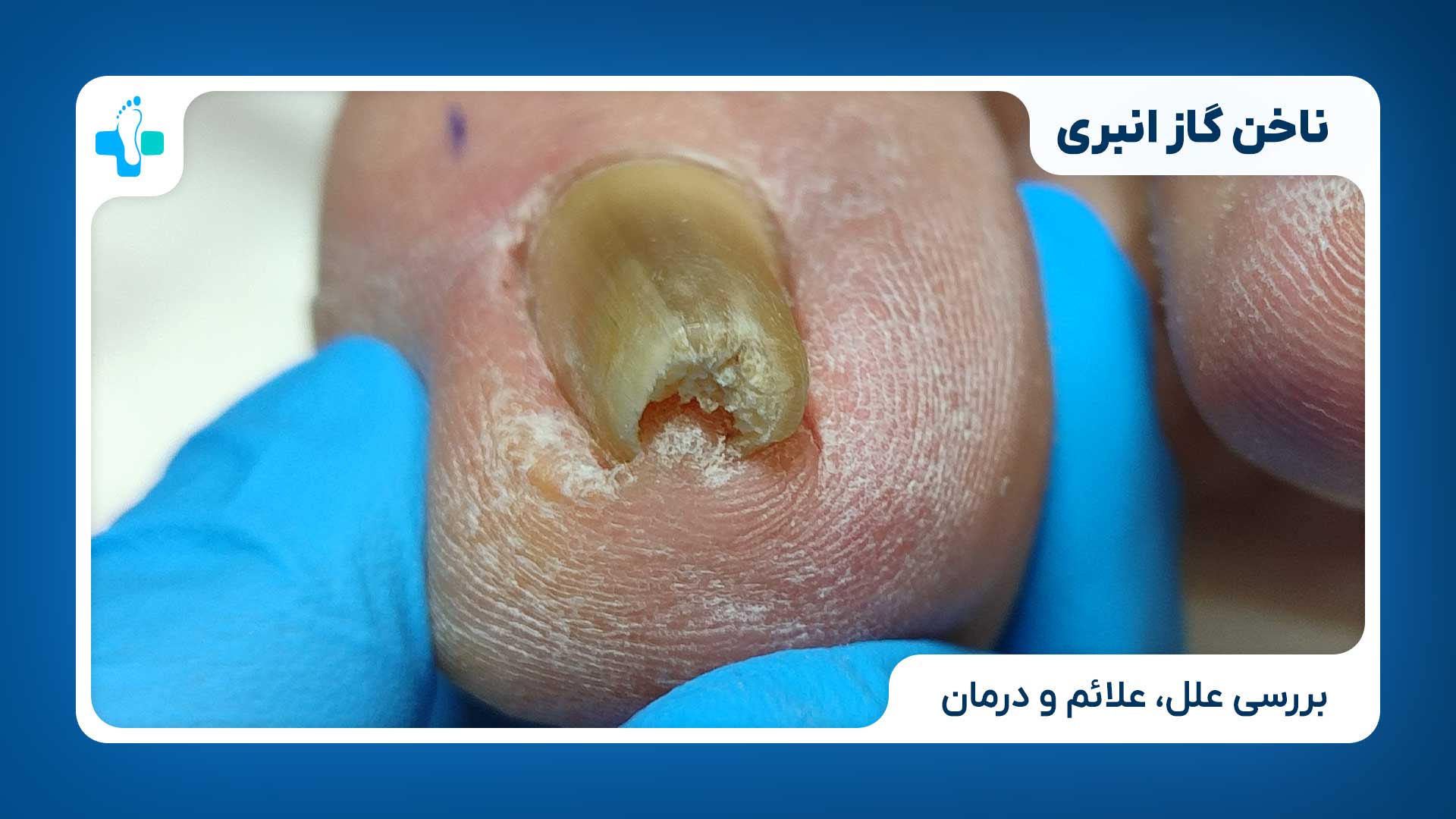 ناخن گاز انبری