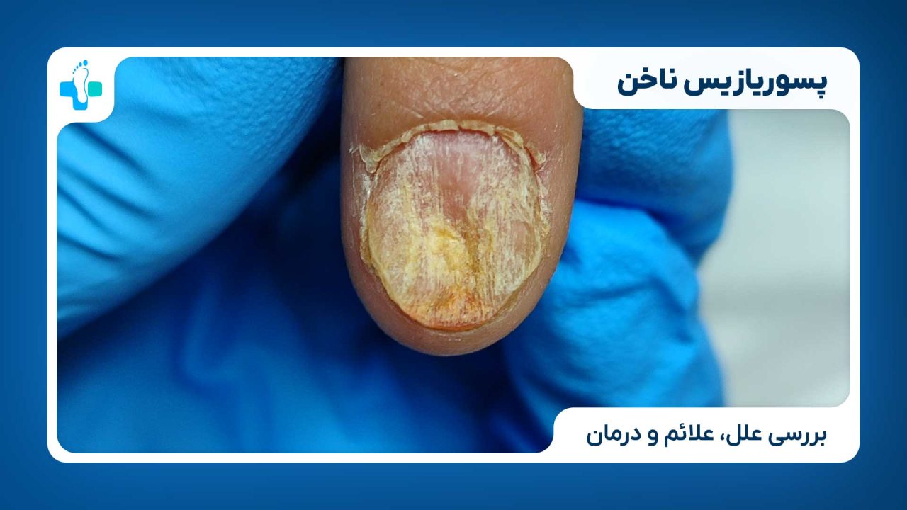 عکس پسوریازیس ناخن