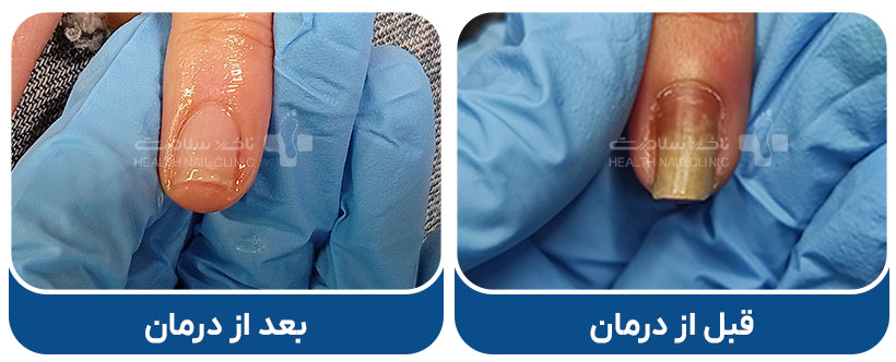 پسوریازیس ناخن درمان شده در کلینیک ناخن سلامت