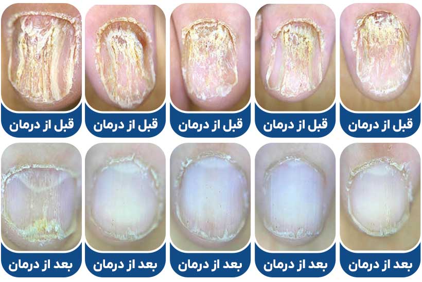 عکس لیکن پلان ناخن درمان شده