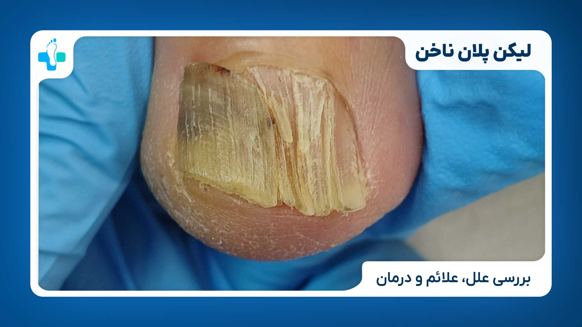 لیکن پلان ناخن